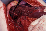 Residual left hemi-liver