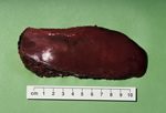 Operative specimen with a tumour nodule in the middle